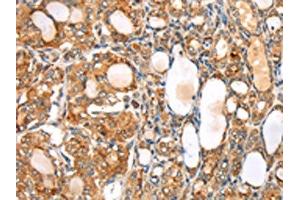 The image on the left is immunohistochemistry of paraffin-embedded Human thyroid cancer tissue using ABIN7192531(SLC8B1 Antibody) at dilution 1/20, on the right is treated with synthetic peptide. (SLC24A6 Antikörper)