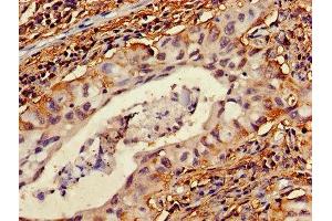 Immunohistochemistry of paraffin-embedded human lung cancer using ABIN7174772 at dilution of 1:100