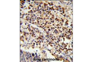 Formalin-fixed and paraffin-embedded human lung carcinoma reacted with , which was peroxidase-conjugated to the secondary antibody, followed by DAB staining. (U2AF1 Antikörper  (AA 99-125))