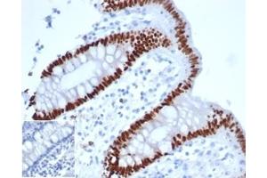 IHC analysis of formalin-fixed, paraffin-embedded human colon adenocarcinoma. (Rekombinanter CDX2 Antikörper)