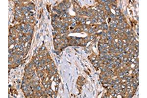 The image on the left is immunohistochemistry of paraffin-embedded Human cervical cancer tissue using ABIN7129551(FUCA1 Antibody) at dilution 1/30, on the right is treated with fusion protein. (FUCA1 Antikörper)