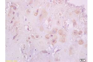 Formalin-fixed and paraffin embedded human placenta tissue labeled with Anti-Phospho-Estrogen Receptor alpha (Ser118) Polyclonal Antibody, Unconjugated (ABIN684568) at 1:200 followed by conjugation to the secondary antibody and DAB staining (Estrogen Receptor alpha Antikörper  (pSer118))