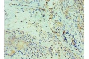 Immunohistochemistry of paraffin-embedded human breast cancer using ABIN7146211 at dilution of 1:100 (Cadherin 13 Antikörper  (AA 120-370))