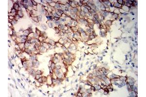 Immunohistochemical analysis of paraffin-embedded ovarian cancer tissues using NCAM1 mouse mAb with DAB staining. (CD56 Antikörper)