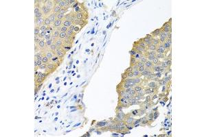Immunohistochemistry of paraffin-embedded human lung cancer using EIF4E antibody (ABIN5971189) at dilution of 1/100 (40x lens). (EIF4E Antikörper)