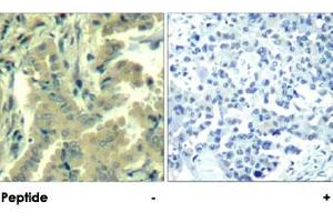 Immunohistochemical analysis of paraffin-embedded human lung carcinoma tissue using PLCG2 polyclonal antibody . (Phospholipase C gamma 2 Antikörper  (Tyr1217))