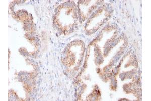 Formalin-fixed, paraffin-embedded human Prostate Carcinoma stained with FOLH1 Rabbit Recombinant Monoclonal Antibody (FOLH1/3149R). (Rekombinanter PSMA Antikörper  (AA 232-433))