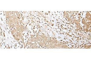Immunohistochemistry of paraffin-embedded Human esophagus cancer tissue using ZKSCAN3 Polyclonal Antibody at dilution of 1:50(x200) (ZKSCAN3 Antikörper)