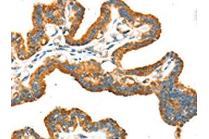 The image on the left is immunohistochemistry of paraffin-embedded Human thyroid cancer tissue using ABIN7192934(TRPV5 Antibody) at dilution 1/25, on the right is treated with synthetic peptide. (TRPV5 Antikörper)