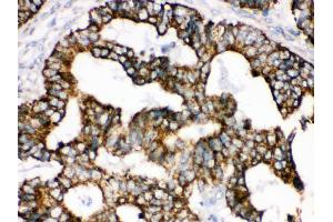 Anti- TRAP1 Picoband antibody, IHC(P) IHC(P): Human Intestinal Cancer Tissue