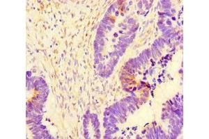 Immunohistochemistry of paraffin-embedded human ovarian cancer using ABIN7171154 at dilution of 1:100 (SYT1 Antikörper  (AA 301-523))