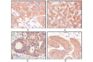 Immunohistochemical analysis of paraffin-embedded human lung squamous cell carcinoma (A),normal hepatocyte (B), colon adenocacinoma, normal stomach tissue (D), showing cytoplasmic and membrane localization using CK antibody with DAB staining.