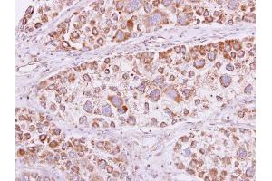 IHC-P Image PSKH1 antibody detects PSKH1 protein at cytooplasm and membrane on human liver carcinoma by immunohistochemical analysis.