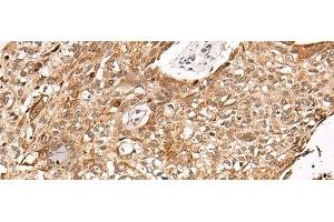 Immunohistochemistry of paraffin-embedded Human lung cancer tissue using C14orf169 Polyclonal Antibody at dilution of 1:45(x200) (C14orf169 + NO66 Antikörper)