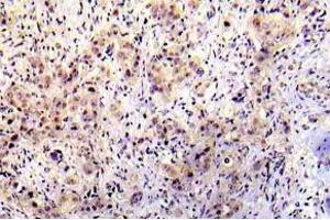 Immunohistochemistry (IHC) analyzes of p-P53 antibody in paraffin-embedded human breast carcinoma tissue. (p53 Antikörper  (pSer20))