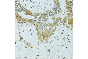 Immunohistochemistry of paraffin-embedded human breast cancer using METTL13 antibody. (METTL13 Antikörper)