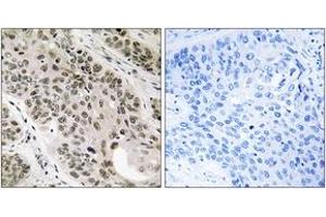 Immunohistochemistry analysis of paraffin-embedded human lung carcinoma tissue, using TNNI3K Antibody.