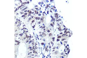 Immunohistochemistry of paraffin-embedded human colon carcinoma using Ku70 Rabbit mAb (ABIN7271407) at dilution of 1:100 (40x lens). (XRCC6 Antikörper)