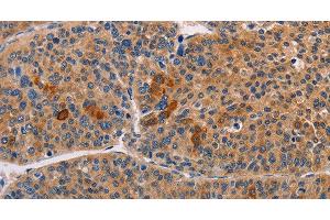 Immunohistochemistry of paraffin-embedded Human liver cancer using ALDH3A1 Polyclonal Antibody at dilution of 1:55 (ALDH3A1 Antikörper)