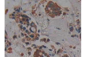 Detection of CK4 in Human Breast cancer Tissue using Polyclonal Antibody to Cytokeratin 4 (CK4)