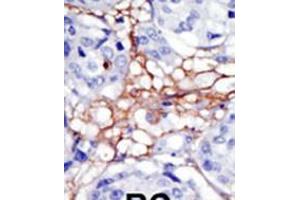 Formalin-fixed and paraffin-embedded human cancer tissue reacted with the primary antibody, which was peroxidase-conjugated to the secondary antibody, followed by DAB staining. (PIP4K2A Antikörper  (N-Term))