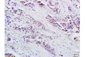 Formalin-fixed and paraffin embedded human colorectal cancer labeled with Anti OCT4B-190 Polyclonal Antibody, Unconjugated  at 1:200 followed by conjugation to the secondary antibody and DAB staining (Oct-4BOCT4B-190NT (AA 201-300) Antikörper)