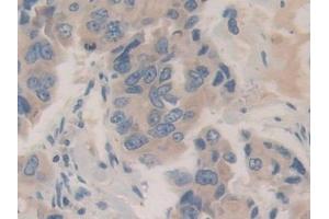 Detection of CHGB in Human Breast cancer Tissue using Polyclonal Antibody to Chromogranin B (CHGB) (CHGB Antikörper  (AA 496-669))