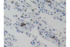 DAB staining on IHC-P; Samples: Human Lung Cancer Tissue (Glucocorticoid Receptor Antikörper  (AA 598-755))