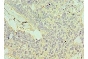 Immunohistochemistry of paraffin-embedded human endometrial cancer using ABIN7154113 at dilution of 1:100 (GSTO2 Antikörper  (AA 124-243))