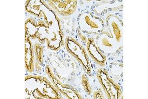 Immunohistochemistry of paraffin-embedded human kidney cancer using GLRX Antibody (ABIN6127980, ABIN6141147, ABIN6141149 and ABIN6220940) at dilution of 1:200 (40x lens). (Glutaredoxin 1 Antikörper  (AA 1-106))