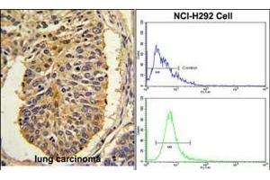 (LEFT)Formalin-fixed and paraffin-embedded human lung carcinoma with CER1 Antibody (N-term), which was peroxidase-conjugated to the secondary antibody, followed by DAB staining. (CER1 Antikörper  (N-Term))