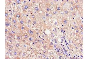 Immunohistochemistry of paraffin-embedded human liver cancer using ABIN7168030 at dilution of 1:100 (RND3 Antikörper  (AA 152-239))