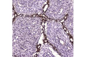 IHC testing of FFPE human breast cancer tissue with Glutathione Reductase antibody at 1ug/ml. (Glutathione Reductase Antikörper)