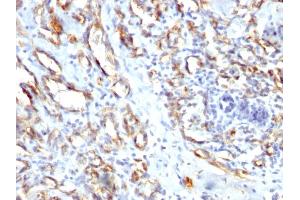 Formalin-fixed, paraffin-embedded human Angiosarcoma stained with CD31 Rabbit Polyclonal Antibody. (CD31 Antikörper)