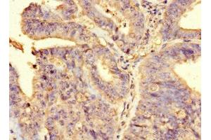 Immunohistochemistry of paraffin-embedded human endometrial cancer using ABIN7167899 at dilution of 1:100