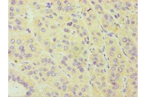 Immunohistochemistry of paraffin-embedded human liver cancer using ABIN7149265 at dilution of 1:100 (CYP3A5 Antikörper  (AA 233-502))