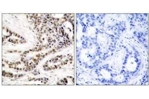 Immunohistochemical analysis of paraffin-embedded human breast carcinoma tissue using CREB (phospho-Ser129) antibody (E011273). (CREB1 Antikörper  (pSer129))