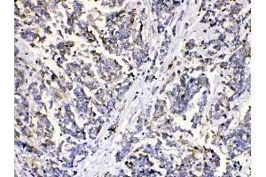 MUT was detected in paraffin-embedded sections of human mammary cancer tissues using rabbit anti- MUT Antigen Affinity purified polyclonal antibody (Catalog # ) at 1 µg/mL. (MUT Antikörper  (N-Term))