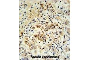 mouse BID Antibody (S61) (ABIN388100 and ABIN2846184) IHC analysis in formalin fixed and paraffin embedded human breast carcinoma followed by peroxidase conjugation of the secondary antibody and DAB staining. (BID Antikörper  (AA 39-68))