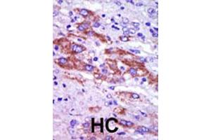Formalin-fixed and paraffin-embedded human hepatocellular carcinoma tissue reacted with CSNK1D polyclonal antibody  , which was peroxidase-conjugated to the secondary antibody, followed by DAB staining. (Casein Kinase 1 delta Antikörper  (C-Term))