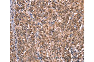Immunohistochemistry of Human liver cancer using GCSAM Polyclonal Antibody at dilution of 1:40 (GCET2 Antikörper)