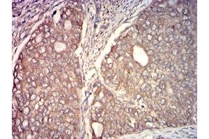 Immunohistochemical analysis of paraffin-embedded cervical cancer tissues using CAPN1 mouse mAb with DAB staining. (CAPNL1 Antikörper  (AA 501-714))