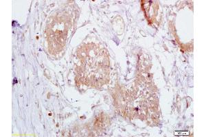 Formalin-fixed and paraffin embedded human breast carcinoma labeled with Anti-CD168/RHAMM Polyclonal Antibody, Unconjugated (ABIN1386755) at 1:200 followed by conjugation to the secondary antibody and DAB staining (HMMR Antikörper  (AA 51-150))
