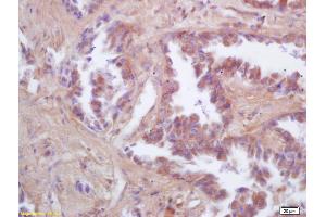 Formalin-fixed and paraffin embedded human lung carcinoma labeled with Rabbit Anti FIS1/TTC11 Polyclonal Antibody, Unconjugated (ABIN872461) at 1:200 followed by conjugation to the secondary antibody and DAB staining (Fission 1 Antikörper  (AA 55-152))