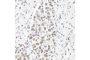 Immunohistochemistry of paraffin-embedded human esophageal cancer using PARP1 antibody at dilution of 1:100 (x40 lens). (PARP1 Antikörper)