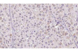 ABIN6277329 at 1/100 staining Human melanoma tissue by IHC-P. (CFHR1 Antikörper  (C-Term))