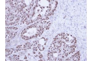 Immunohistochemical staining of paraffin-embedded NCIN87 Xenograft using TAP antibody at a dilution of 1:100 (NXF1 Antikörper)