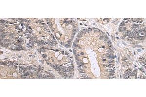Immunohistochemistry of paraffin-embedded Human gastric cancer tissue using PPM1K Polyclonal Antibody at dilution of 1:55(x200)