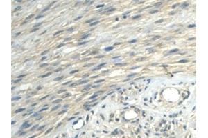 Detection of ALDH1A2 in Human Uterine fibroids Tissue using Polyclonal Antibody to Aldehyde Dehydrogenase 1 Family, Member A2 (ALDH1A2)