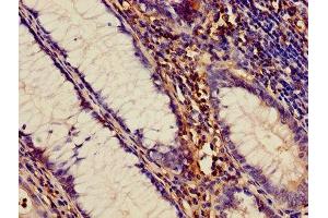 Immunohistochemistry of paraffin-embedded human colon cancer using ABIN7150034 at dilution of 1:100 (A Disintegrin and Metallopeptidase Domain 1a (ADAM1A) (AA 214-504) Antikörper)
